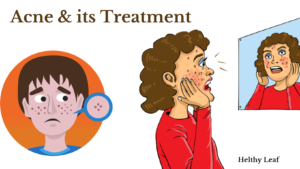 Acne problem and treatment