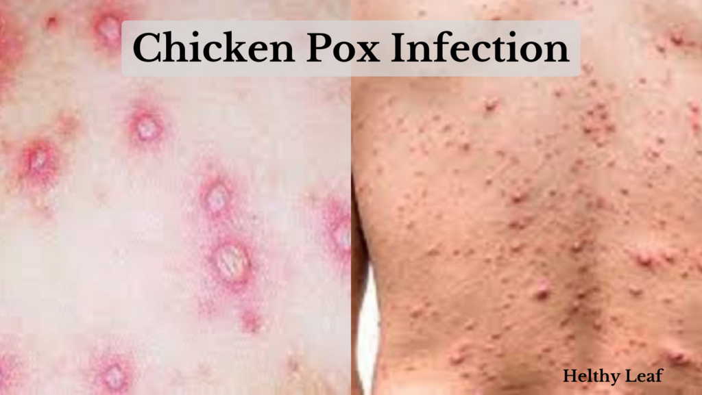 Chicken pox infection