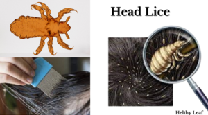 health & lice