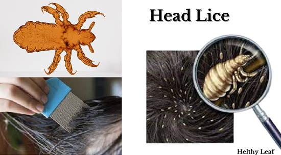 Important Health Tips to Treat and Prevent Lice - Helthy Leaf