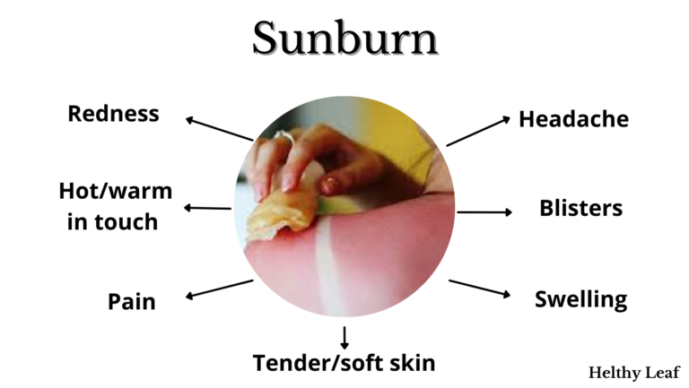 Sunburn health