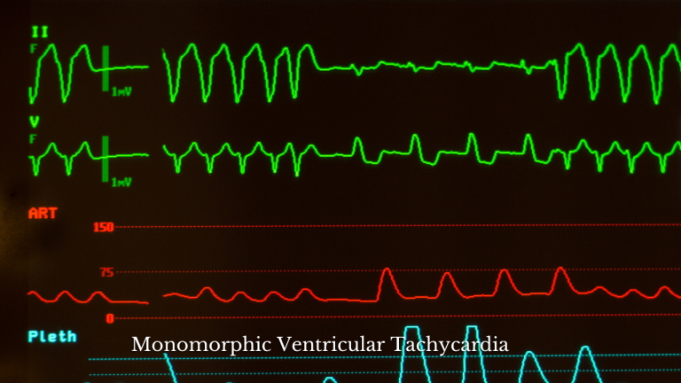 Monomorphic Ventricular Tachycardia Treatment