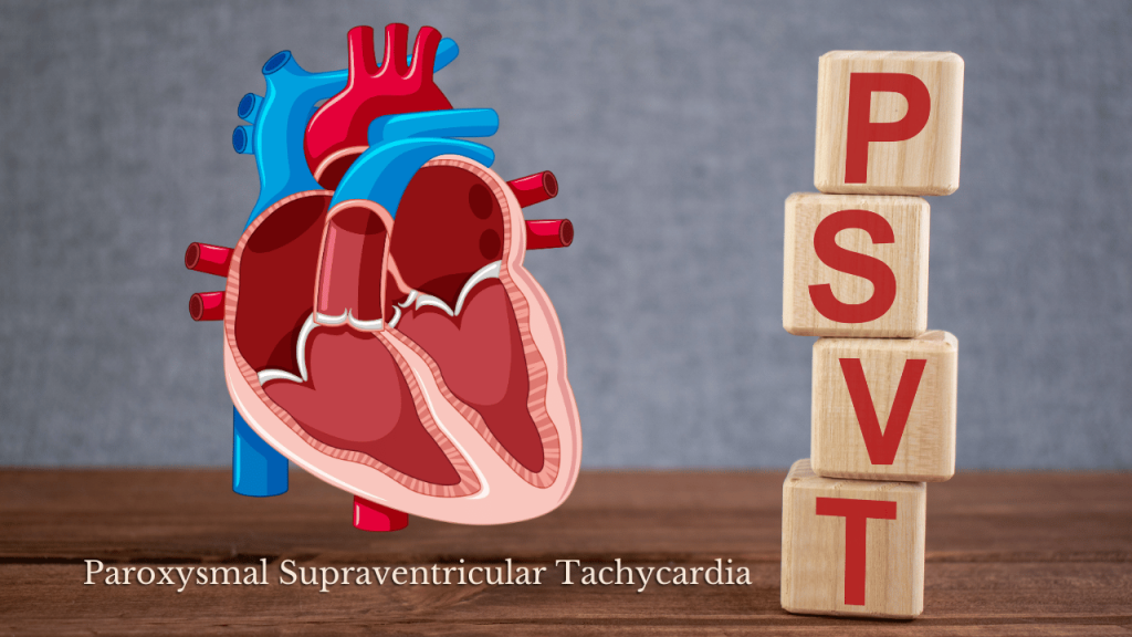 Paroxysmal Supraventricular Tachycardia