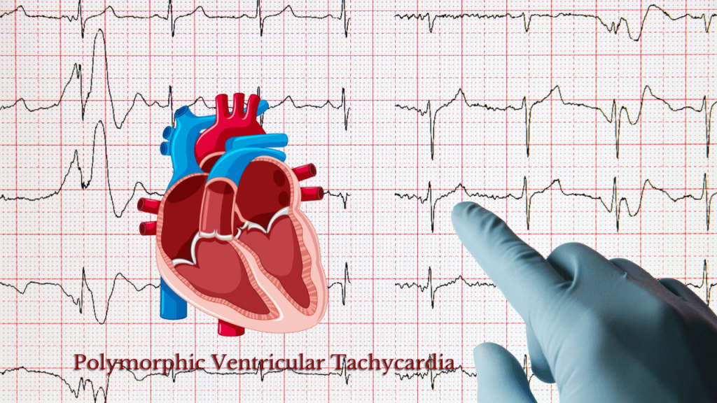 Polymorphic Ventricular Tachycardia